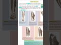 Bone 🦴 fracture types 🦴💯 #information #foryou #howto