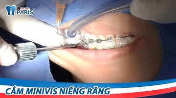Cận cảnh quá trình cắm Minivis rút ngắn 6 tháng niềng răng