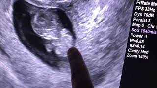 Sonogram: 10 weeks pregnant....and twins too!