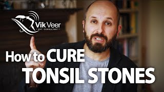 How to Cure Tonsil Stones