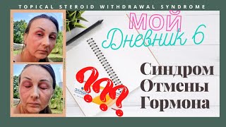 : 6. :    .  . Topical Steroid Withdrawal Syndrome.