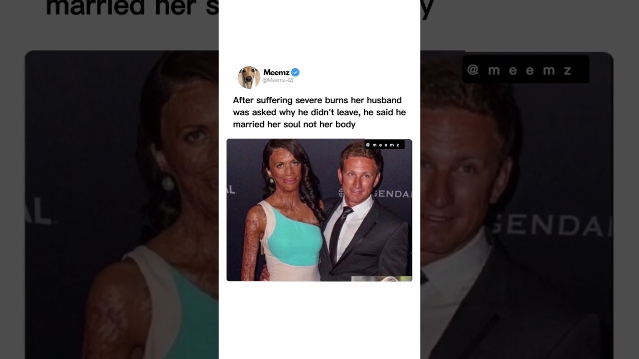 True Love Beyond Scars and Beauty