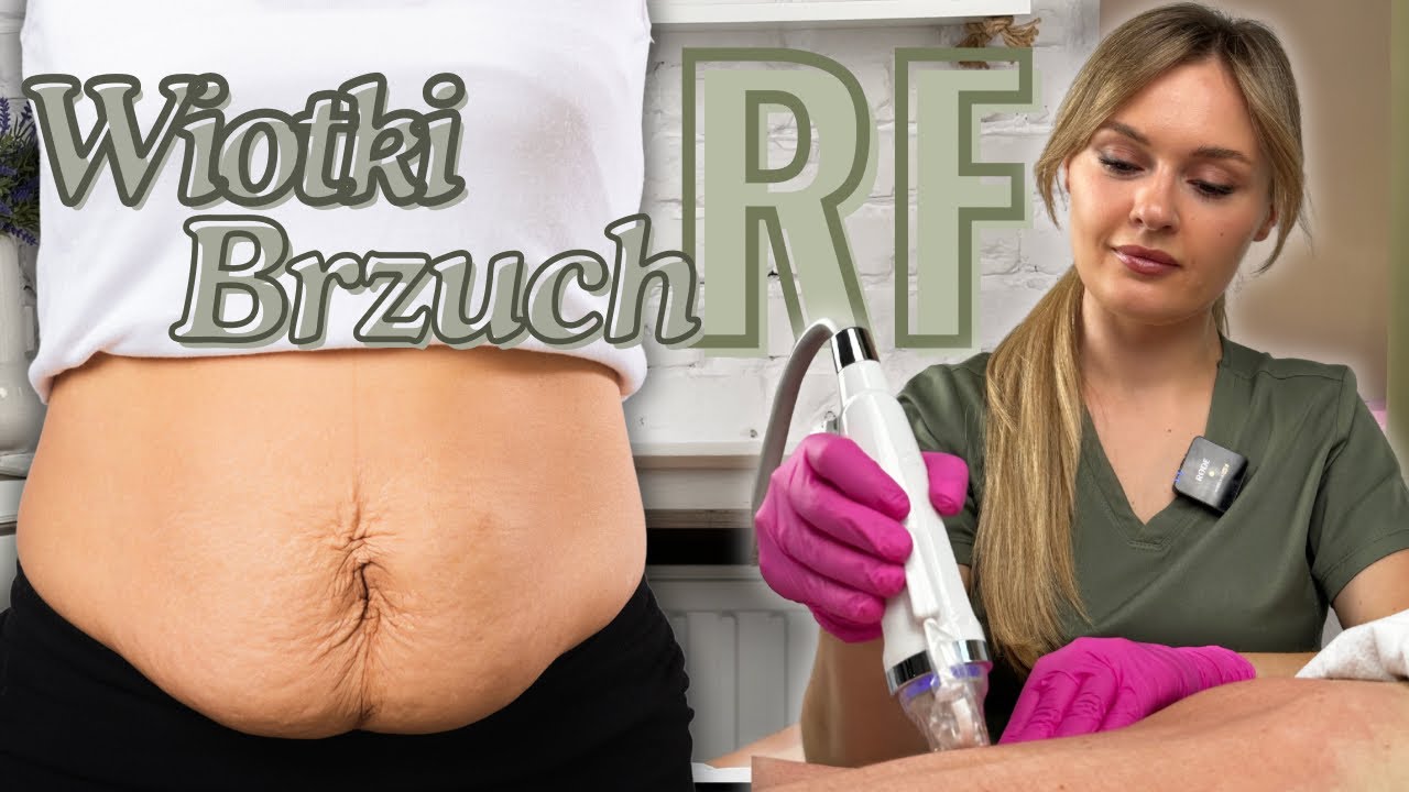JAKI ZABIEG NA WIOTKI BRZUCH? - RADIOFREKWENCJA MIKROIGŁOWA | RF || BRZUCH PO CIĄŻY