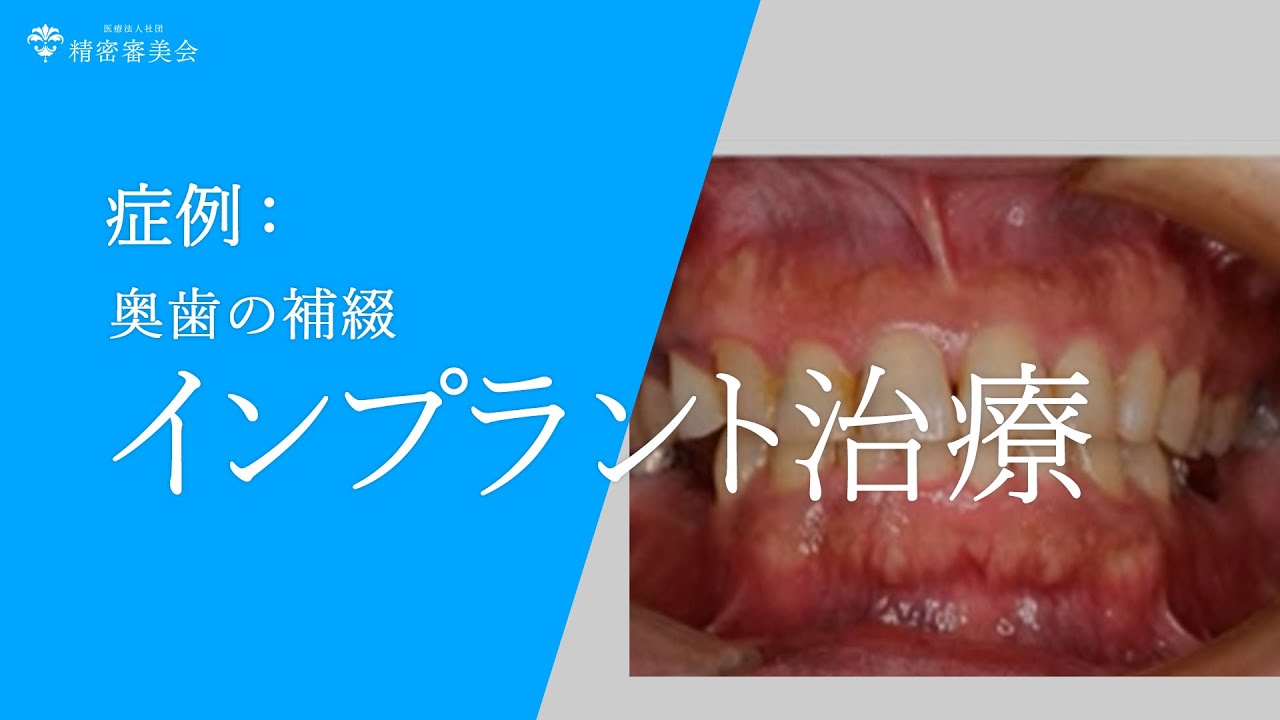 がちゃさん専用 インプラント裏技帖と大技帖50 柴原清隆 インプラント