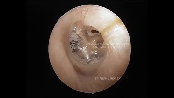 Stapedial reflex Acoustic Reflex