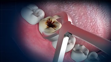 Decay tooth extraction