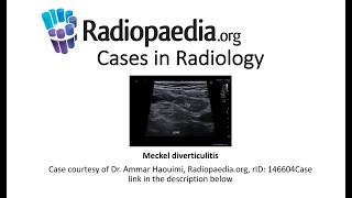 Meckel diverticulitis (Radiopaedia.org) Cases in Radiology