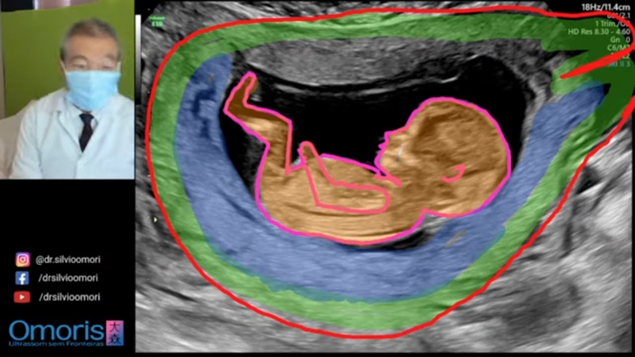 ULTRASSONOGRAFIA: Gestação de 12 semanas.
