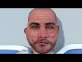 Facial Reconstruction Surgery Animation