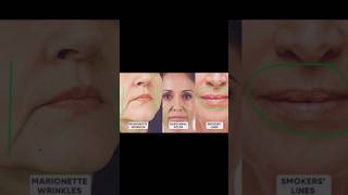 how to remove smile lines from face naturally♨️