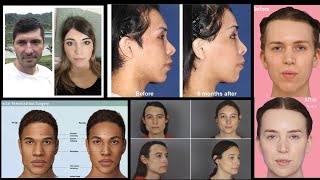 Male to Female (MTF) Facial Feminization