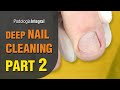 Deep nail cleaning [Part 2] Feet with hyperhidrosis