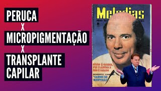 Qual diferença transplante , prótese capilar e micropigmentação ? Silvio Santos é #calvo? #careca ?