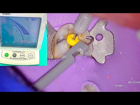 Electronic Apex Locator - Root Canal Working Length Determination