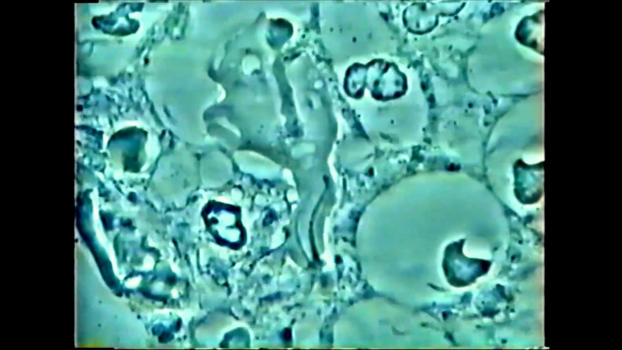 entamoeba gingivalis periodontitis y diabetes entamoeba gingivalis periodontitis y diabetes
