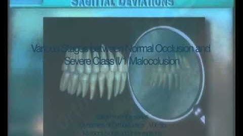 Clip 33: Various Stages Between Normal Occlusion and Severe Class II/1 Malocclusion