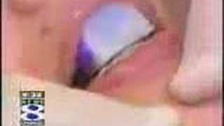 Headaches Migraines Tmj Stamford Ct Dentist Dr Jerry Simon