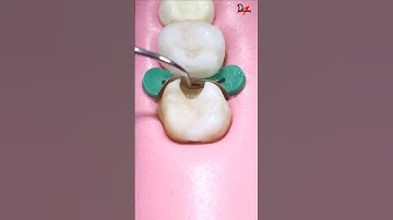 Perfect Cavity Filling #Satisfying #asmr