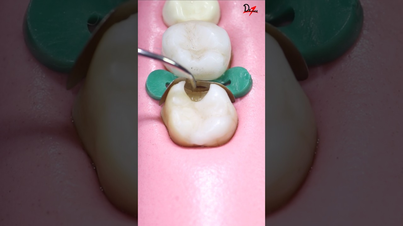 Perfect Cavity Filling #Satisfying #asmr