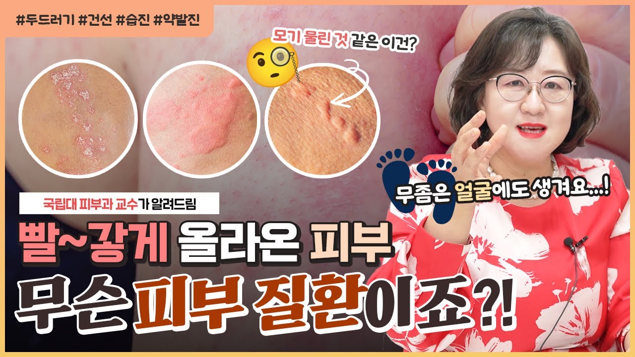 빨개진 피부, 대체 무슨 피부 질환일까?🤔|두드러기? 습진? 약발진? 🚫'이런 경우'는 진짜 심각한 거예요!🚫 - [언니네피부과 ...