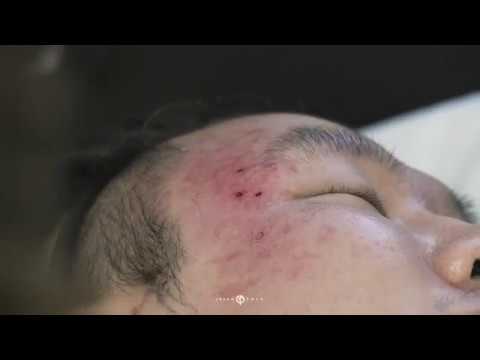 Punch Excision | Acne Scar Treatment | Beverly Hills, CA