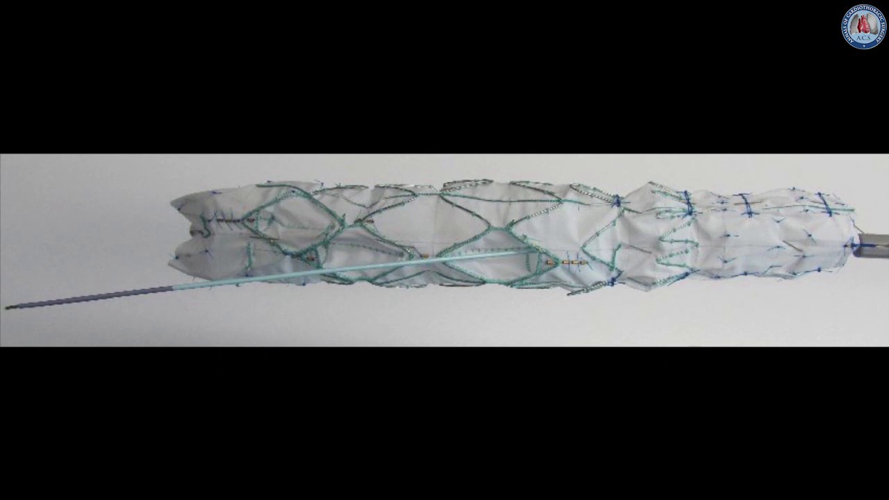 Эндоваскулярное замещение дуги аорты эндопротезом с тремя внутренними браншами