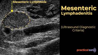 Mesenteric Lymphadenitis Ultrasound (Scanning Protocol & Diagnostic Criteria)