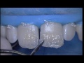 Esthetic restoration of central superior incisors