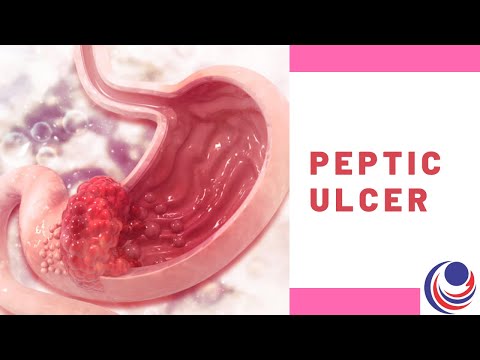 Peptic Ulcer: a Painful Ulceration in the Stomach