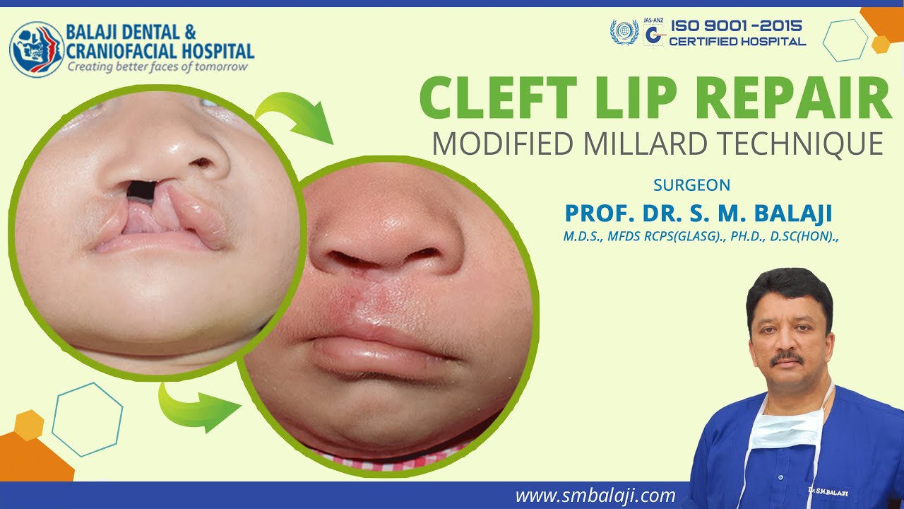 Cleft Lip Repair Surgery Modified Millard Technique YouTube