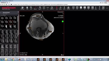 Bone Marrow Segmentation 3D Matlab Projects