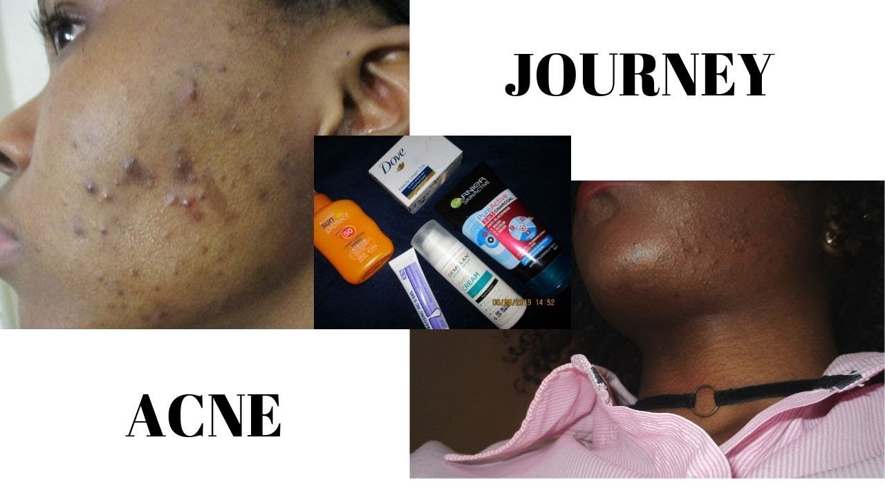 MY ACNE JOURNEY: THE JOURNEY TO CLEAR SKIN | SOUTH AFRICAN YOUTUBER ...