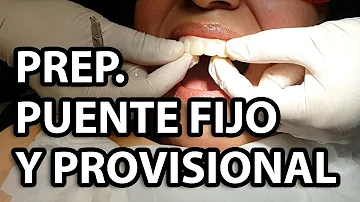 ¿Cómo se prepara un dentista para un puente?