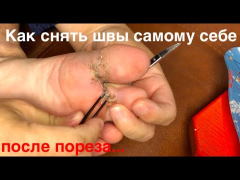 Как снять швы самому себе после пореза. Как самому снять швы. Кака снять швы видео. Снять шов нога