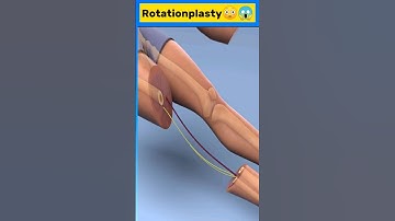 (3D Animation) What is Rotationplasty #animation #youtubeshorts #shorts