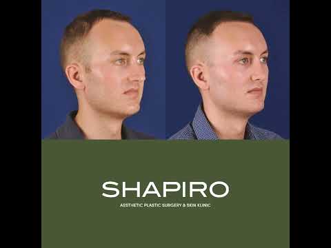 Video thumbnail: Dr. Daniel I. Shapiro | Male Revision Rhinoplasty #shorts · Daniel I. Shapiro (MD)