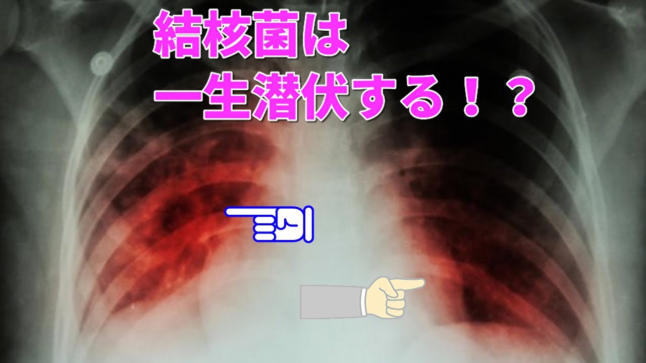 結核の症状と早期発見