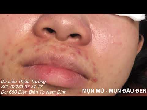 NẶN MỤN MỦ, MỤN VIÊM, MỤN ĐẦU ĐEN QUANH MŨI CỦA BẠN NỮ HỌC SINH