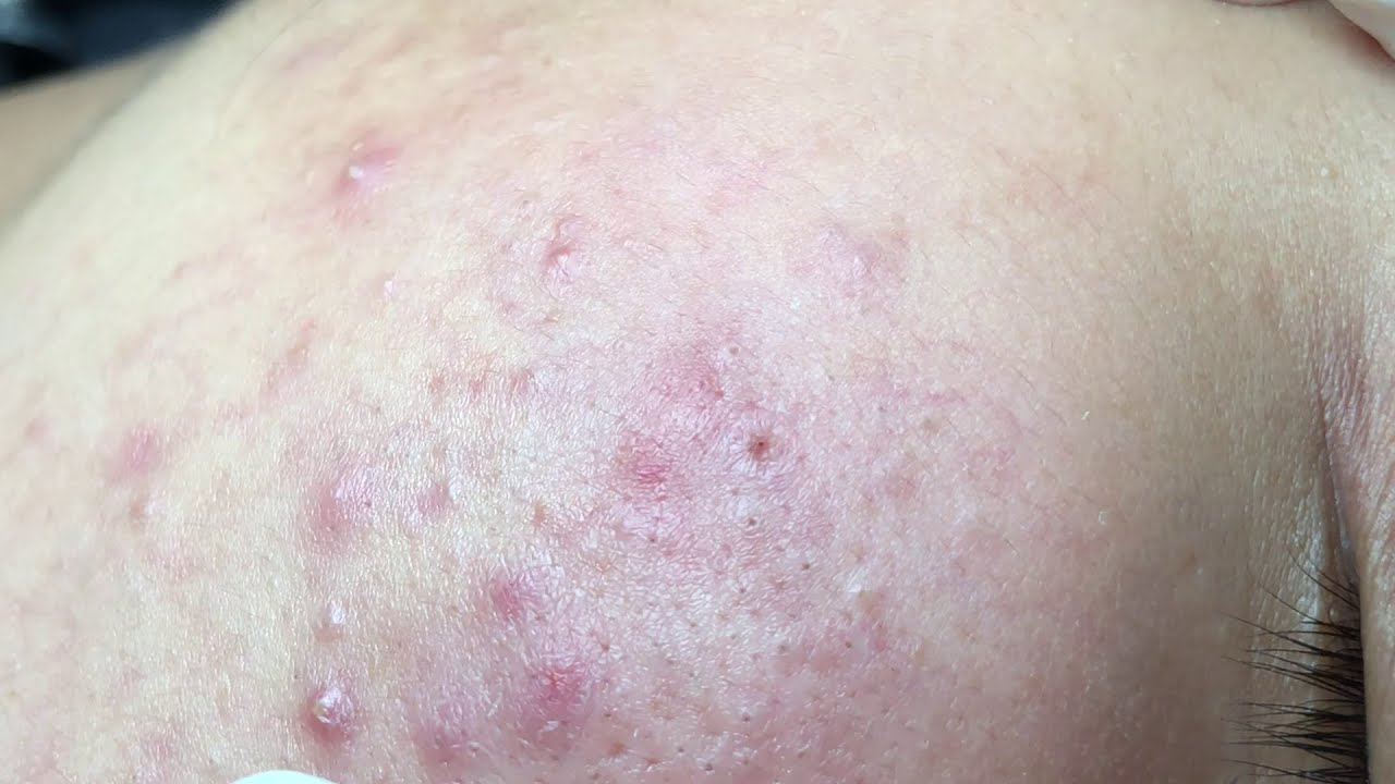 Video acne on days social isolation in VN - YouTube
