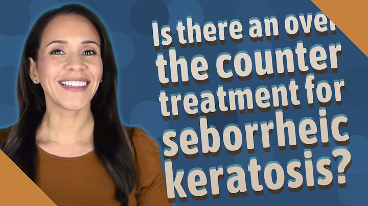 Over the counter treatment for seborrheic dermatitis