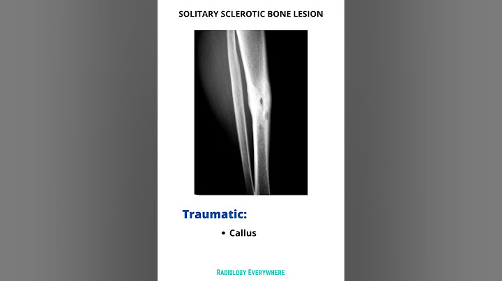 Lytic-sclerotic lesion trong y khoa nghĩa là gì