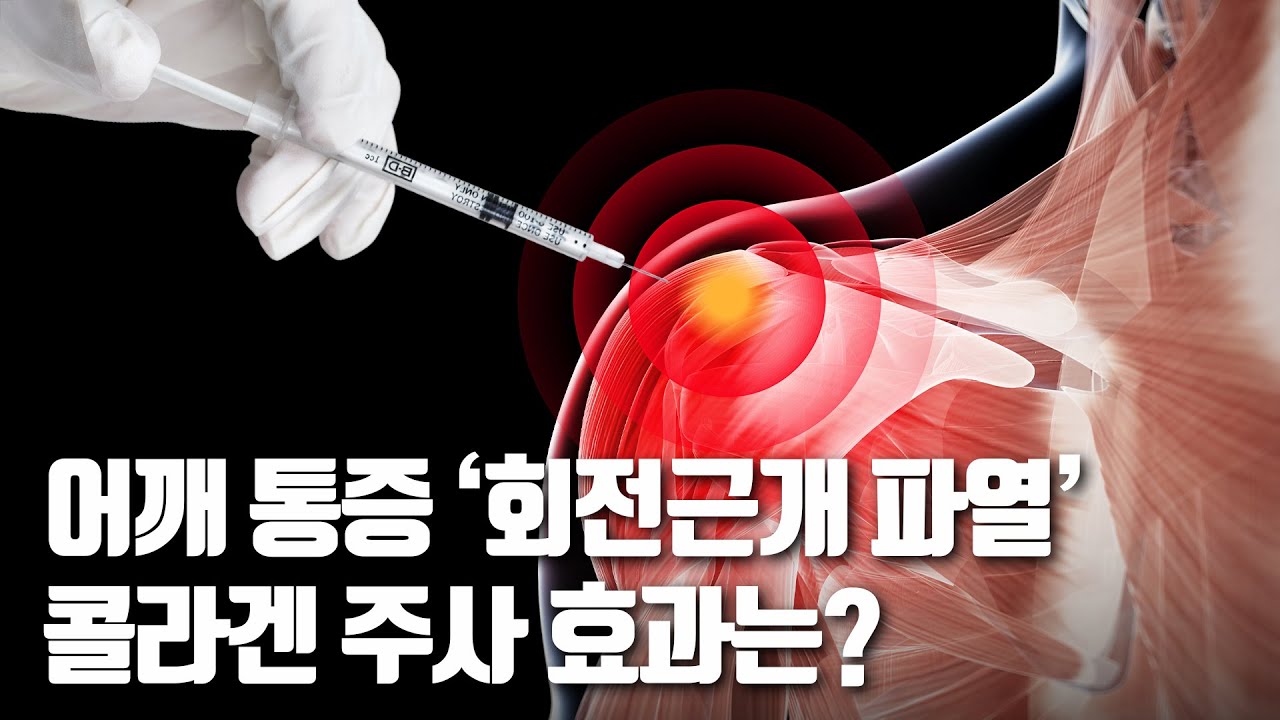 비수술적 회전근개 파열 치료, 콜라겐 주사의 가능성! - YouTube