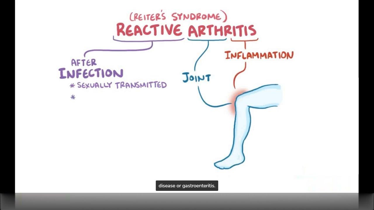 Reactive Arthritis Causes, Symptoms, Diagnosis & Treatment (Pathology