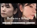 【 ほうれい線 】糸リフト・くま取り・鼻修正・貴族手術（人工真皮）／経過報告【 40代 】