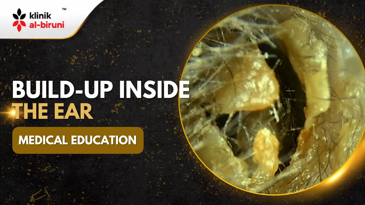Crust Build Up In Ear Build-Up Inside The Ear - YouTube
