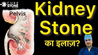 Pelvic Kidney Stone Treatment | Kidney Stone( RIRS)laser kidney stone surgery- Dr. Deepanshu Gupta