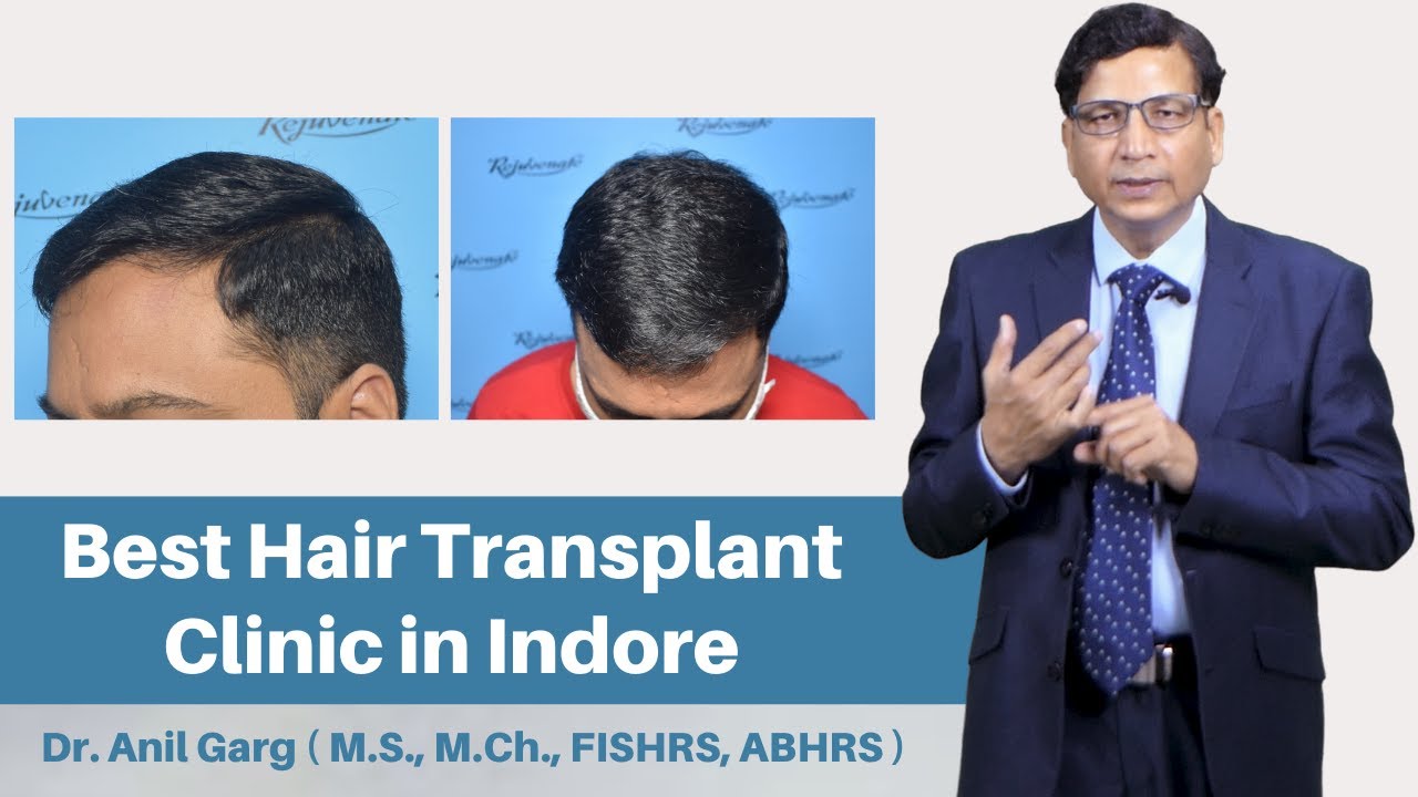 Everything About Hair Transplant  Hair Transplantation in USA