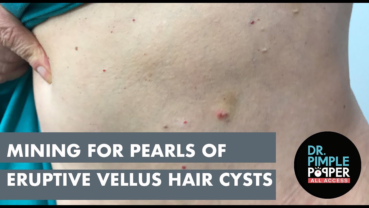 Mining for Pearls of Eruptive Vellus Hair Cysts YouTube