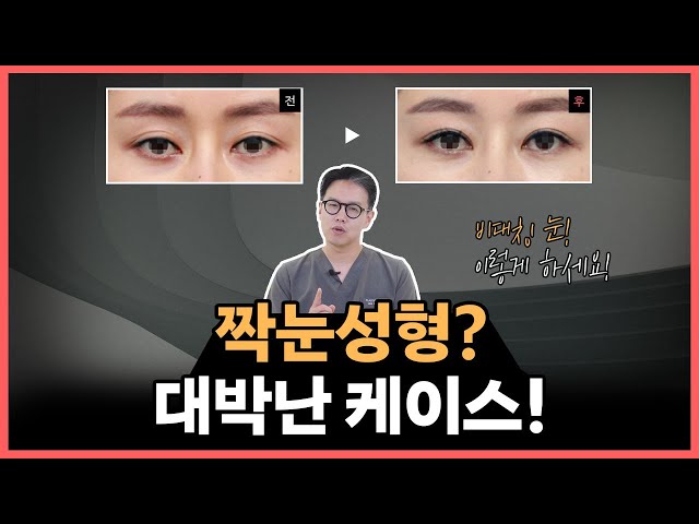 짝눈성형? 비대칭 눈성형의 모든 것! ㅣ 짝눈 수술 케이스 리뷰