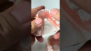 Upper and lower FiberFlex partials for Dr. Michael Connally in Texas